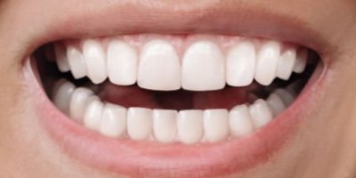 Después del tratamiento, caso 2