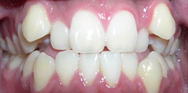 Antes del tratamiento, caso 1