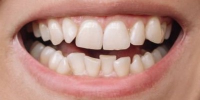 Antes del tratamiento, caso 2