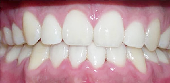 Después del tratamiento, caso 1